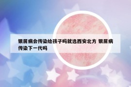 银屑病会传染给孩子吗就选西安北方 银屑病传染下一代吗