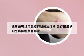 银屑病可以用免疫抑制剂治疗吗 治疗银屑病的免疫抑制剂有哪些