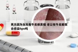 男方因为女方有牛皮癣离婚 老公有牛皮廨我会感染hpv吗