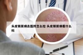 头皮银屑病去医院怎么检 头皮银屑病看什么科