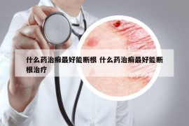 什么药治癣最好能断根 什么药治癣最好能断根治疗