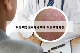 银屑病是国家几级病证 银屑病分几类