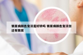 银屑病颜色变淡是好转吗 银屑病颜色变淡但还有银屑