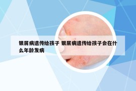 银屑病遗传给孩子 银屑病遗传给孩子会在什么年龄发病