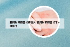 胳膊肘和膝盖长癣图片 胳膊肘和膝盖长了小红疹子