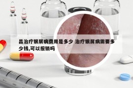 昌治疗银屑病费用是多少 治疗银屑病需要多少钱,可以报销吗