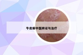 牛皮癣中医辨证与治疗