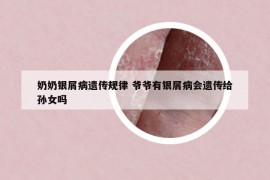 奶奶银屑病遗传规律 爷爷有银屑病会遗传给孙女吗