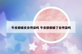 牛皮癣破皮会传染吗 牛皮肤癣破了会传染吗