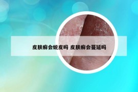 皮肤癣会蜕皮吗 皮肤癣会蔓延吗