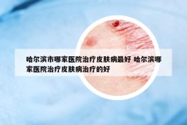 哈尔滨市哪家医院治疗皮肤病最好 哈尔滨哪家医院治疗皮肤病治疗的好