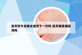 后天性牛皮癣会遗传下一代吗 后天银屑病遗传吗