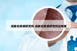 成都皮肤病研究所 成都皮肤病研究所在哪里