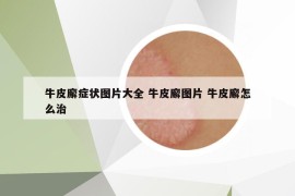 牛皮廨症状图片大全 牛皮廨图片 牛皮廨怎么治