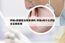 阿维a胶囊能治银屑病吗 阿维a和什么药配合治银屑病