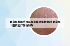 北京那些医院可以打皮肤病生物制剂 北京哪个医院能打生物制剂