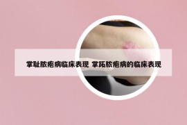 掌耻脓疱病临床表现 掌跖脓疱病的临床表现