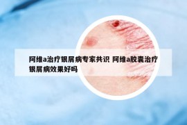 阿维a治疗银屑病专家共识 阿维a胶囊治疗银屑病效果好吗