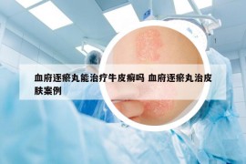 血府逐瘀丸能治疗牛皮癣吗 血府逐瘀丸治皮肤案例