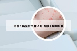 面部长癣是什么样子的 面部长癣的症状