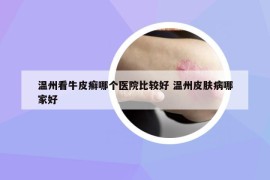 温州看牛皮癣哪个医院比较好 温州皮肤病哪家好