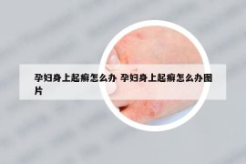 孕妇身上起癣怎么办 孕妇身上起癣怎么办图片