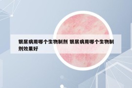 银屑病用哪个生物制剂 银屑病用哪个生物制剂效果好