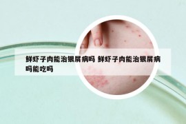 鲜虾子肉能治银屑病吗 鲜虾子肉能治银屑病吗能吃吗