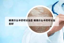 癣用什么中药可以治愈 癣用什么中药可以治愈好