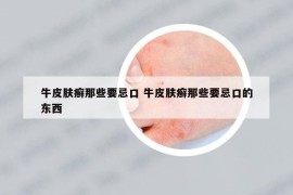 牛皮肤癣那些要忌口 牛皮肤癣那些要忌口的东西