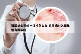 银屑病公司统一体检怎么办 银屑病对入职体检有要求吗