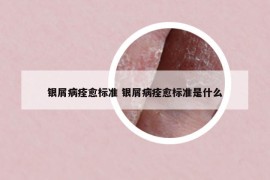 银屑病痊愈标准 银屑病痊愈标准是什么