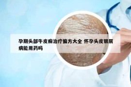 孕期头部牛皮癣治疗偏方大全 怀孕头皮银屑病能用药吗