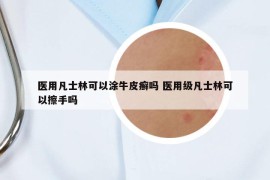 医用凡士林可以涂牛皮癣吗 医用级凡士林可以擦手吗