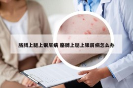 胳膊上腿上银屑病 胳膊上腿上银屑病怎么办