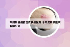 阜阳银屑病首选皮肤病医院 阜阳皮肤病医院有限公司