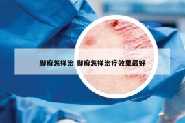 脚癣怎样治 脚癣怎样治疗效果最好