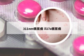 311nm银屑病 il17a银屑病