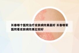 长春哪个医院治疗皮肤病效果最好 长春哪家医院看皮肤病效果比较好