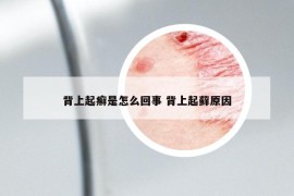 背上起癣是怎么回事 背上起藓原因