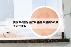 美国308激光治疗银屑病 银屑病308激光治疗贵吗