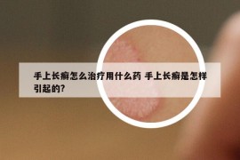 手上长癣怎么治疗用什么药 手上长癣是怎样引起的?