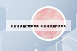 松脂可以治疗银屑病吗 松脂可以治白头发吗