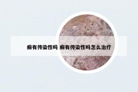 癣有传染性吗 癣有传染性吗怎么治疗