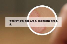 胃疼和牛皮癣有什么关系 银屑病跟胃有关系么