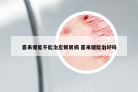 喜来健能不能治愈银屑病 喜来健能治好吗