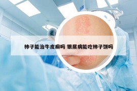 柿子能治牛皮癣吗 银屑病能吃柿子饼吗