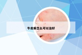 牛皮癣怎么可以治好