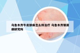 乌鲁木齐牛皮肤癣怎么样治疗 乌鲁木齐银屑病研究所