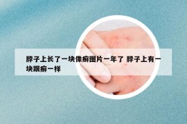 脖子上长了一块像癣图片一年了 脖子上有一块跟癣一样